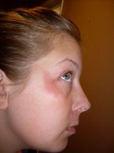 This is the burn, fresh. I wanted to show you it fresh because it's kind of gross now, all brown and scabby, like a crusty birth mark.